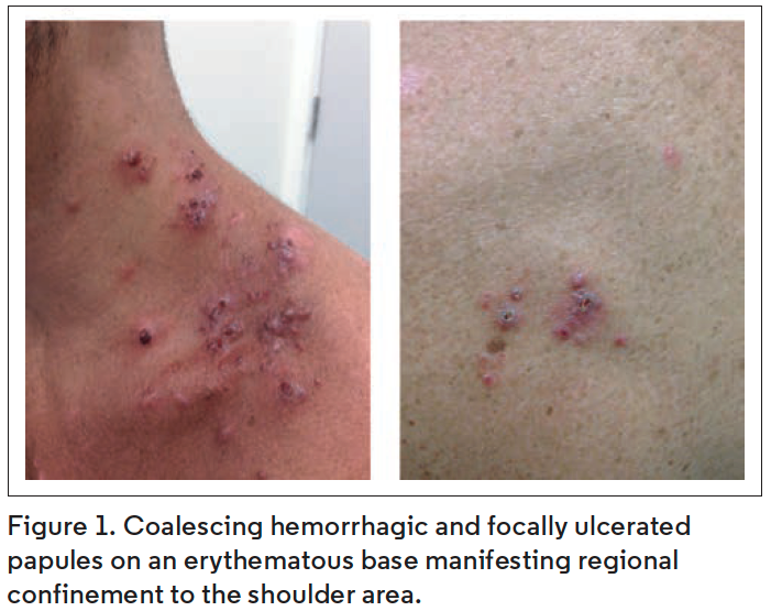 Eruptive Cutaneous Epithelioid Angiomatous Nodules